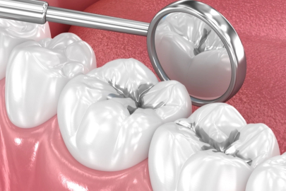 Amalgam Dolgular Değiştirilmeli mi?